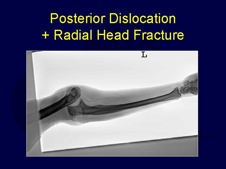 Posterior Dislocation + Radial Head Fracture 