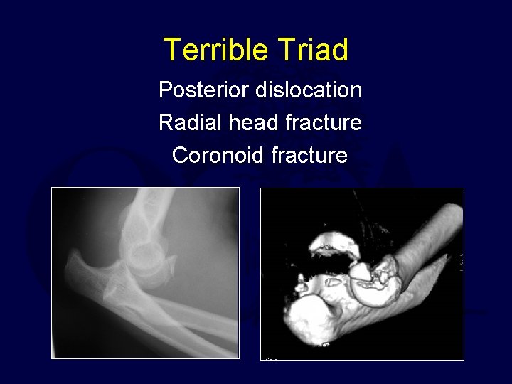 Terrible Triad Posterior dislocation Radial head fracture Coronoid fracture 