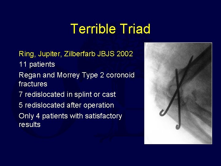 Terrible Triad Ring, Jupiter, Zilberfarb JBJS 2002 11 patients Regan and Morrey Type 2