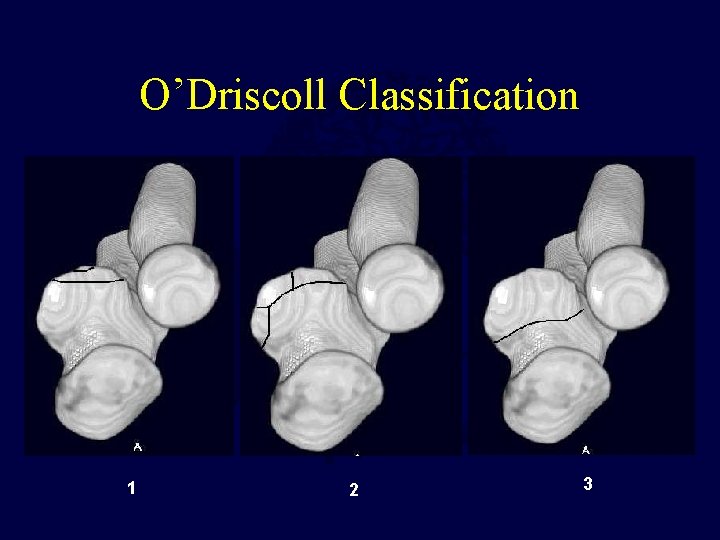 O’Driscoll Classification 1 2 3 