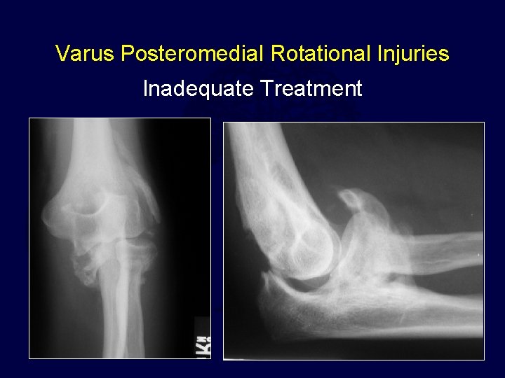 Varus Posteromedial Rotational Injuries Inadequate Treatment 