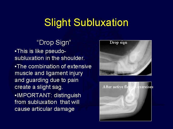 Slight Subluxation “Drop Sign” • This is like pseudosubluxation in the shoulder. • The