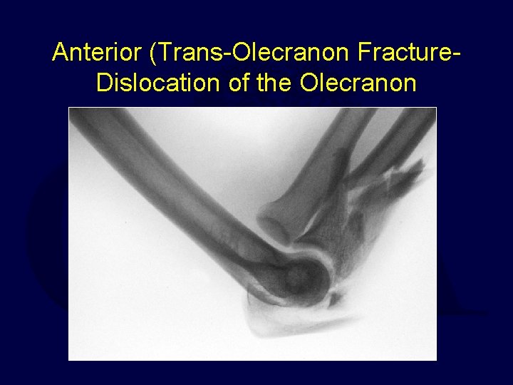 Anterior (Trans-Olecranon Fracture. Dislocation of the Olecranon 