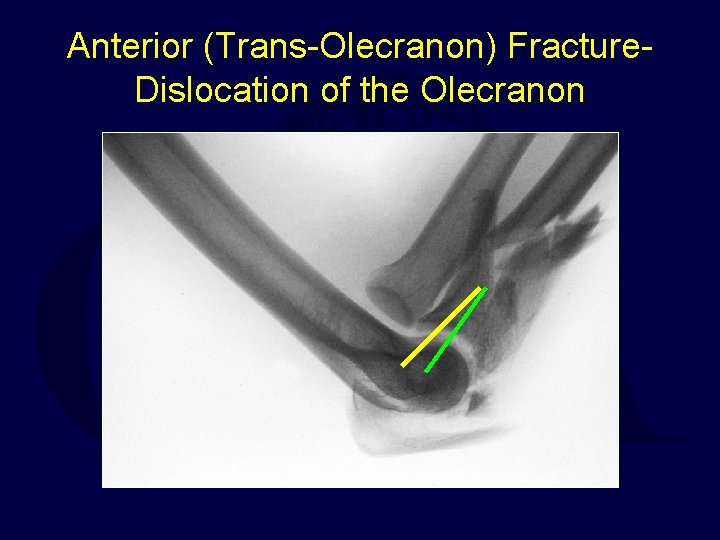 Anterior (Trans-Olecranon) Fracture. Dislocation of the Olecranon 