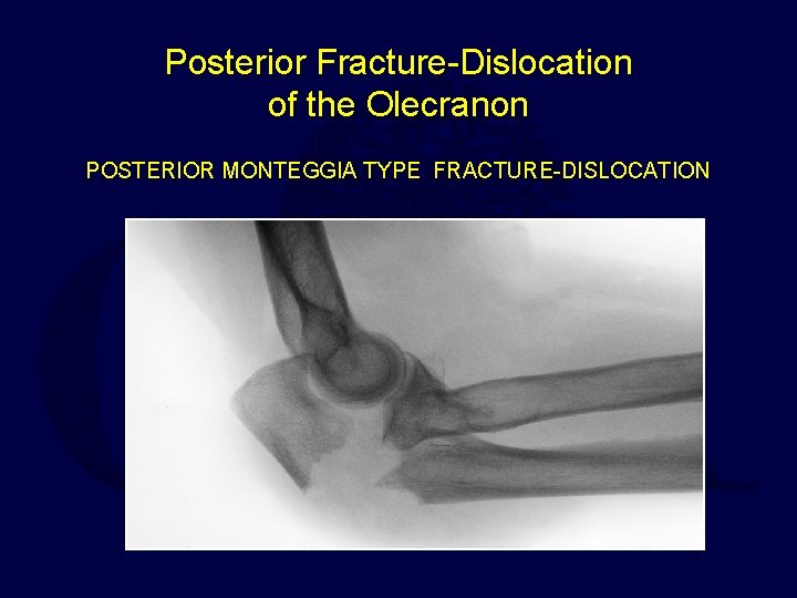 Posterior Fracture-Dislocation of the Olecranon POSTERIOR MONTEGGIA TYPE FRACTURE-DISLOCATION 