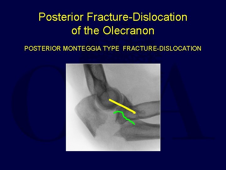 Posterior Fracture-Dislocation of the Olecranon POSTERIOR MONTEGGIA TYPE FRACTURE-DISLOCATION 