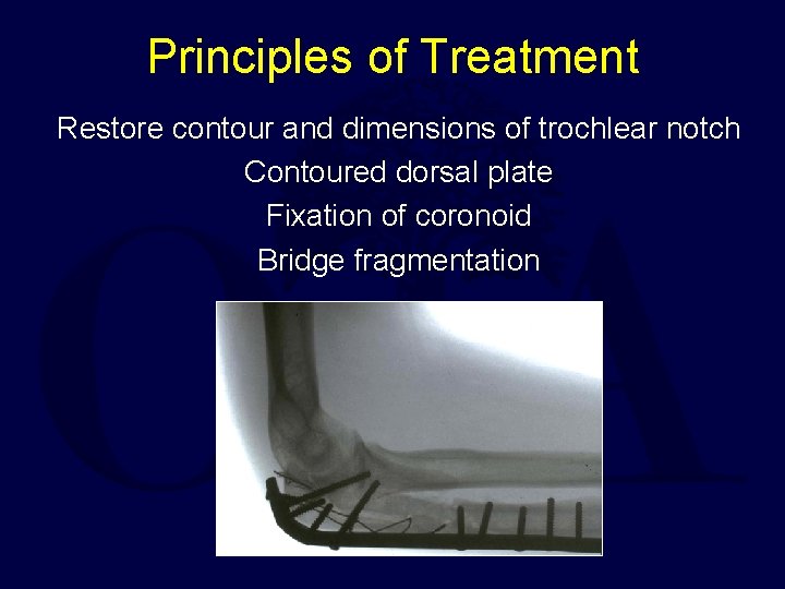 Principles of Treatment Restore contour and dimensions of trochlear notch Contoured dorsal plate Fixation