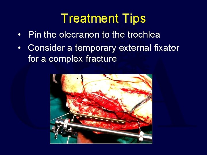 Treatment Tips • Pin the olecranon to the trochlea • Consider a temporary external