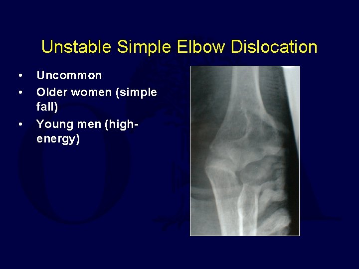 Unstable Simple Elbow Dislocation • • • Uncommon Older women (simple fall) Young men