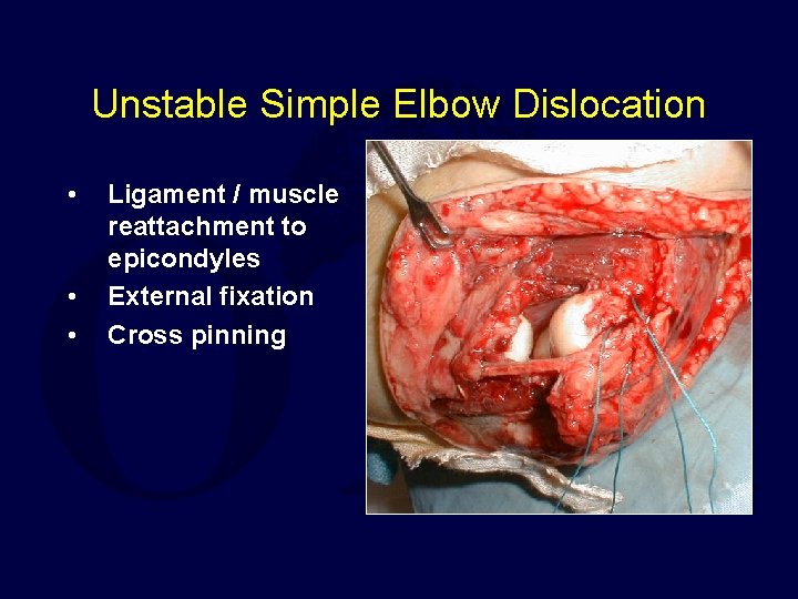 Unstable Simple Elbow Dislocation • • • Ligament / muscle reattachment to epicondyles External