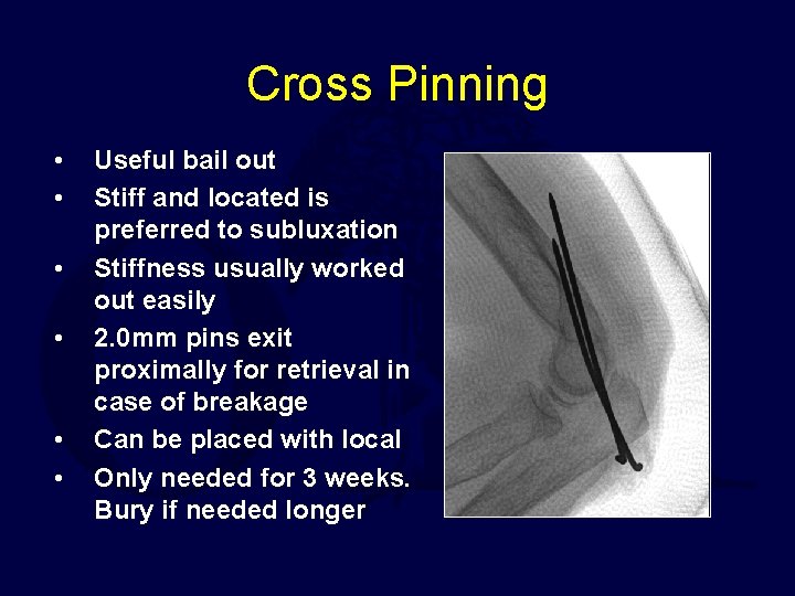 Cross Pinning • • • Useful bail out Stiff and located is preferred to