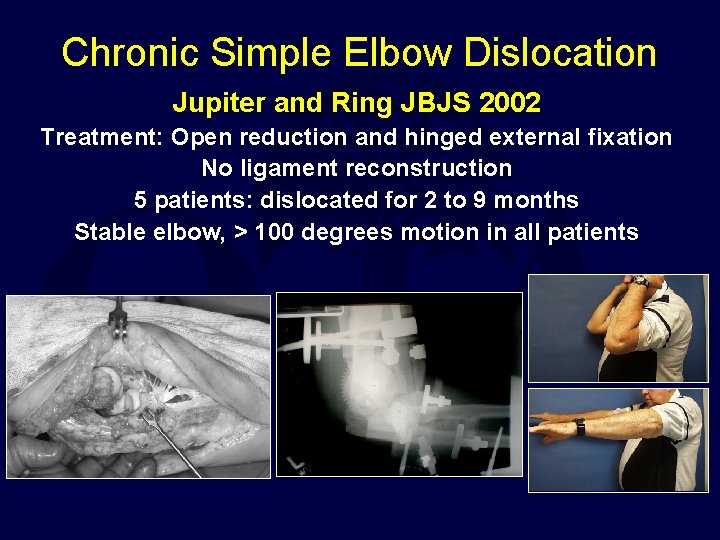 Chronic Simple Elbow Dislocation Jupiter and Ring JBJS 2002 Treatment: Open reduction and hinged