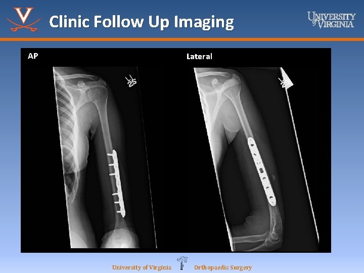 Clinic Follow Up Imaging AP Lateral University of Virginia Orthopaedic Surgery 