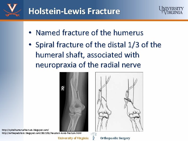 Holstein-Lewis Fracture • Named fracture of the humerus • Spiral fracture of the distal