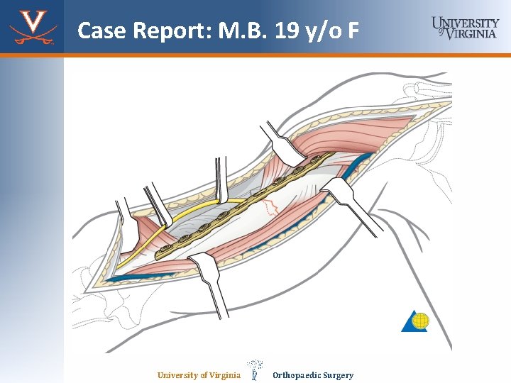 Case Report: M. B. 19 y/o F University of Virginia Orthopaedic Surgery 