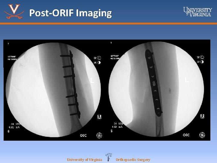 Post-ORIF Imaging University of Virginia Orthopaedic Surgery 