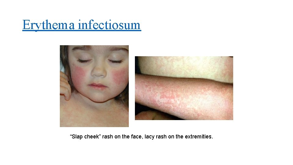 Erythema infectiosum “Slap cheek” rash on the face, lacy rash on the extremities. 