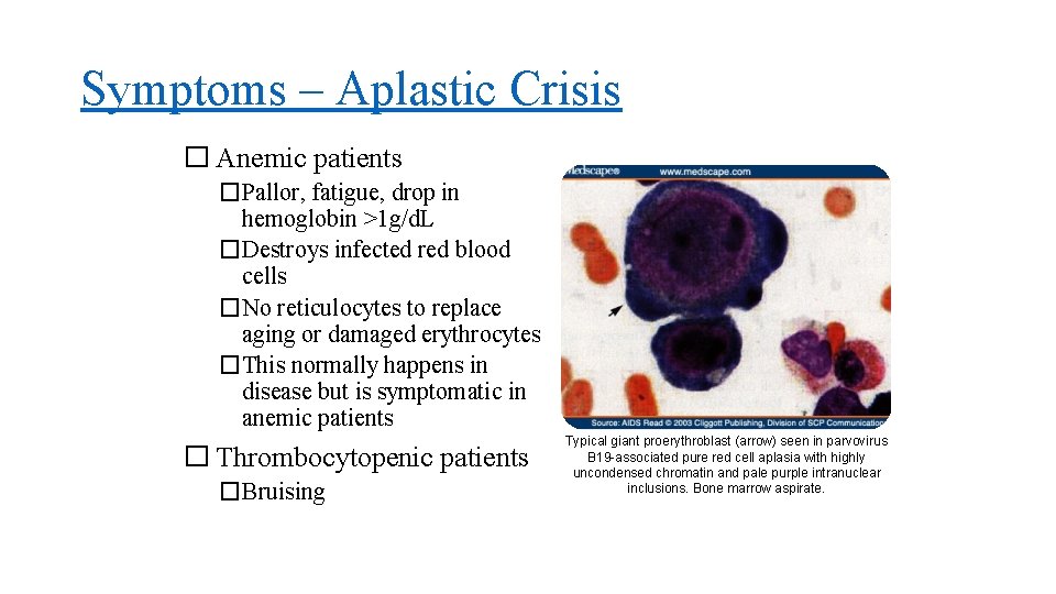 Symptoms – Aplastic Crisis � Anemic patients �Pallor, fatigue, drop in hemoglobin >1 g/d.