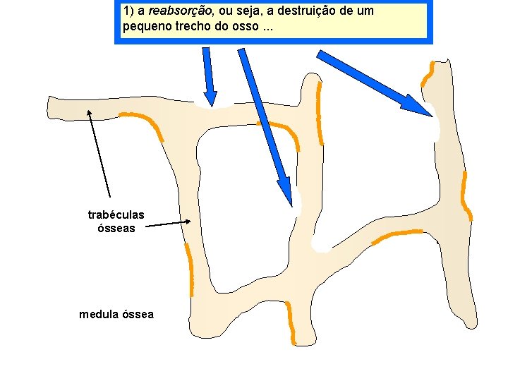 1) a reabsorção, ou seja, a destruição de um pequeno trecho do osso. .