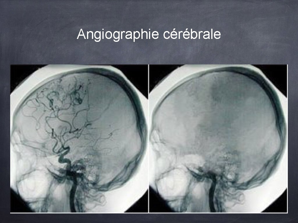 Angiographie cérébrale 