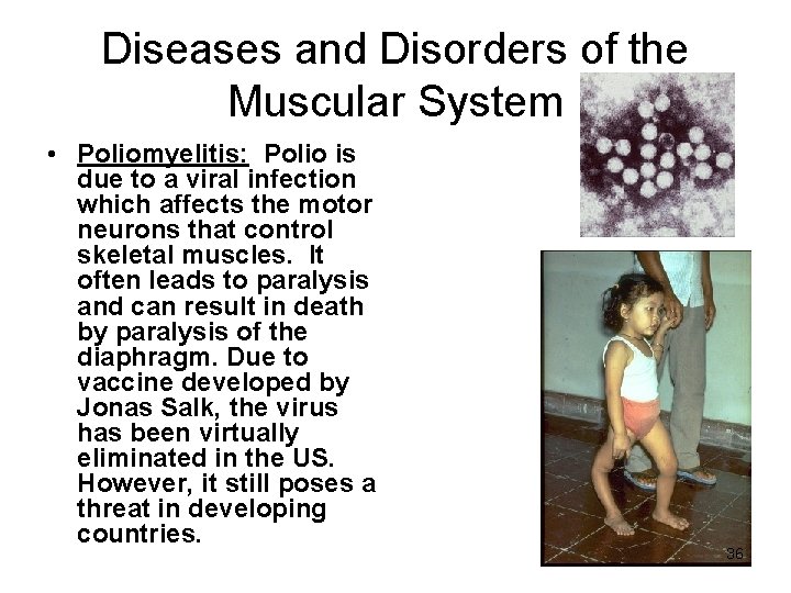 Diseases and Disorders of the Muscular System • Poliomyelitis: Polio is due to a