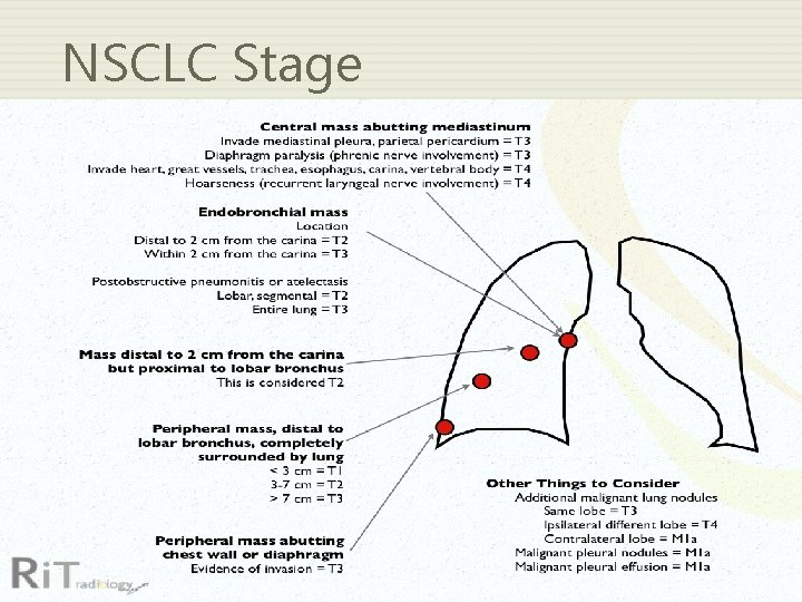 NSCLC Stage 