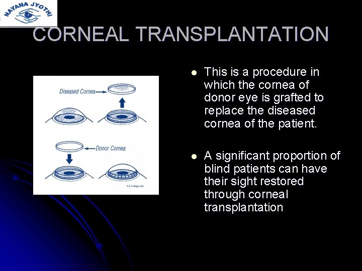 CORNEAL TRANSPLANTATION l This is a procedure in which the cornea of donor eye