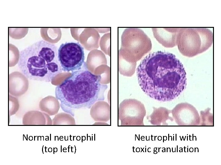 Normal neutrophil (top left) Neutrophil with toxic granulation 