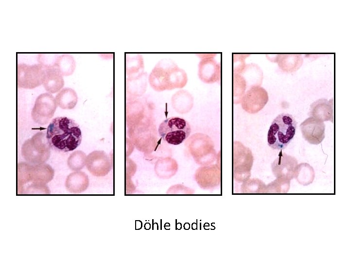 Döhle bodies 