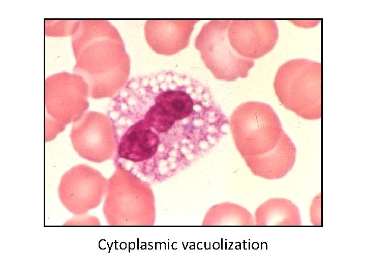 Cytoplasmic vacuolization 