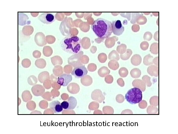 Leukoerythroblastotic reaction 