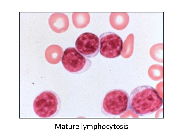 Mature lymphocytosis 