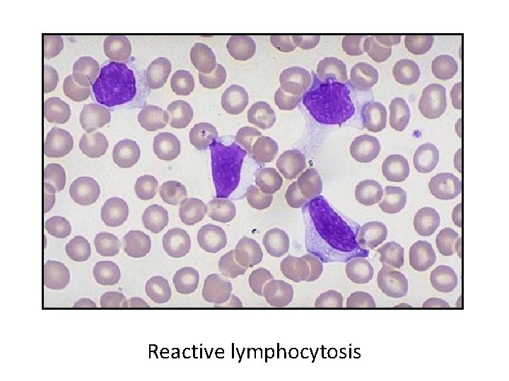 Reactive lymphocytosis 