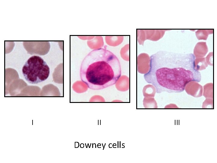 I II Downey cells III 