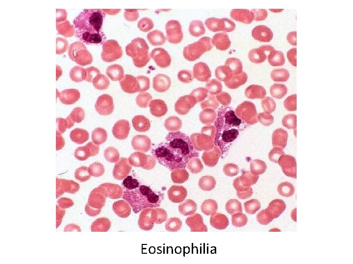  • Eosinophilia 