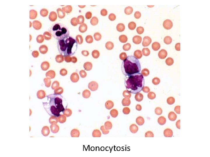  • Monocytosis 