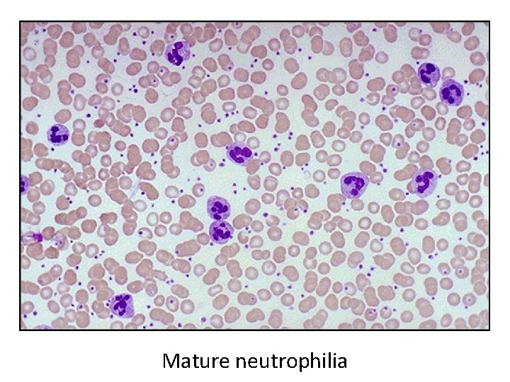 Mature neutrophilia 