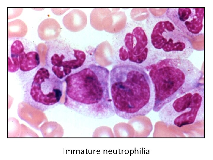 Immature neutrophilia 