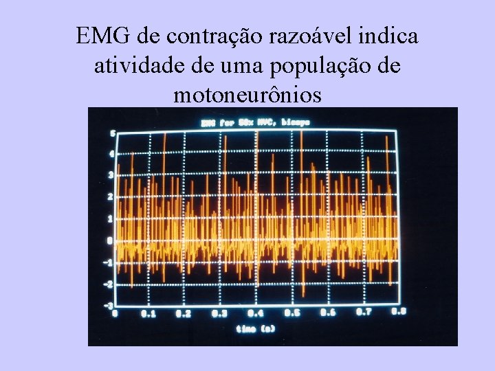 EMG de contração razoável indica atividade de uma população de motoneurônios 