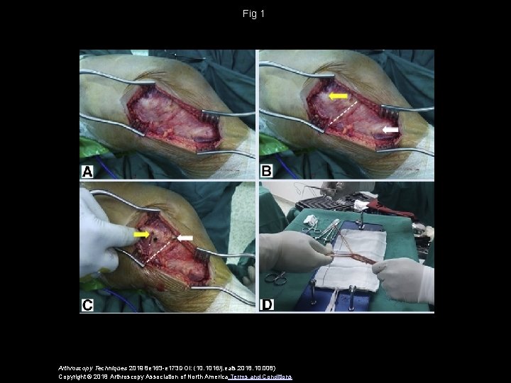 Fig 1 Arthroscopy Techniques 2019 8 e 163 -e 173 DOI: (10. 1016/j. eats.