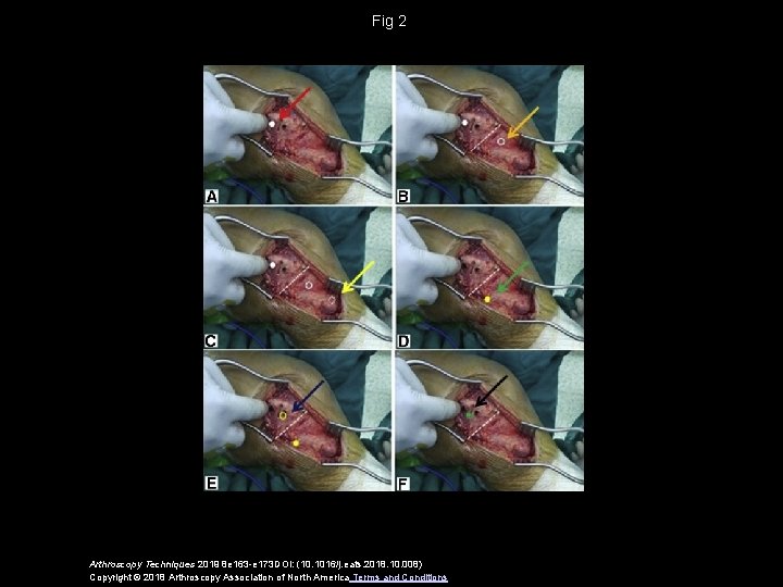 Fig 2 Arthroscopy Techniques 2019 8 e 163 -e 173 DOI: (10. 1016/j. eats.