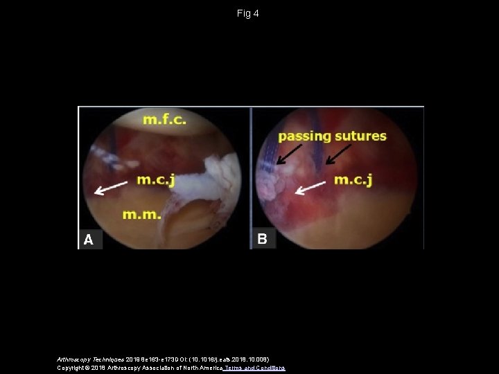 Fig 4 Arthroscopy Techniques 2019 8 e 163 -e 173 DOI: (10. 1016/j. eats.