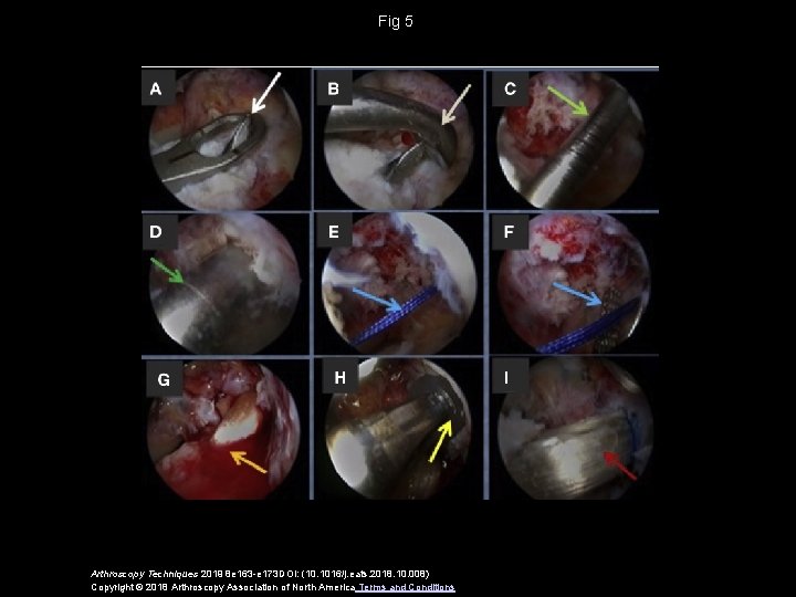 Fig 5 Arthroscopy Techniques 2019 8 e 163 -e 173 DOI: (10. 1016/j. eats.