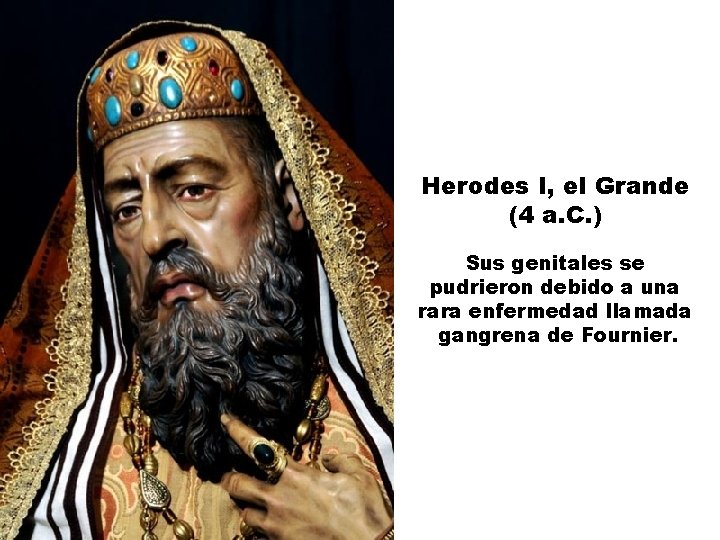 Herodes I, el Grande (4 a. C. ) Sus genitales se pudrieron debido a