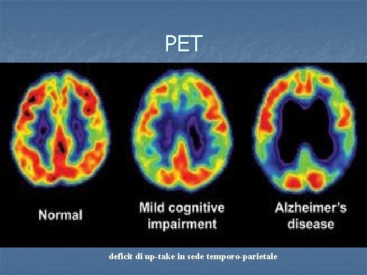 PET deficit di up-take in sede temporo-parietale 