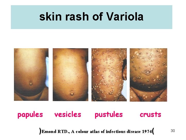 skin rash of Variola papules vesicles pustules crusts )Emond RTD. , A colour atlas