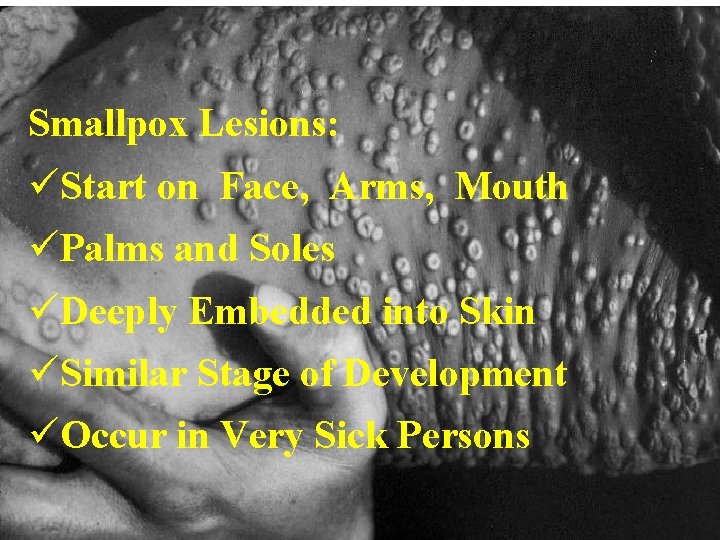 Smallpox Lesions: üStart on Face, Arms, Mouth üPalms and Soles üDeeply Embedded into Skin