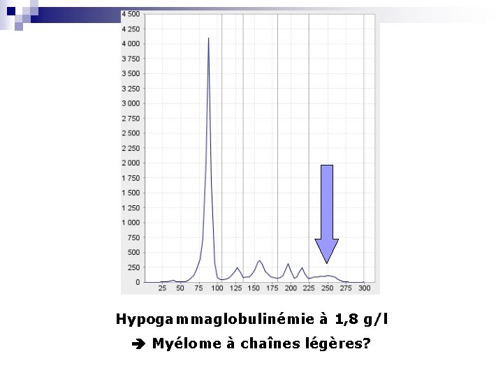 Hypogammaglobulinémie à 1, 8 g/l Myélome à chaînes légères? 