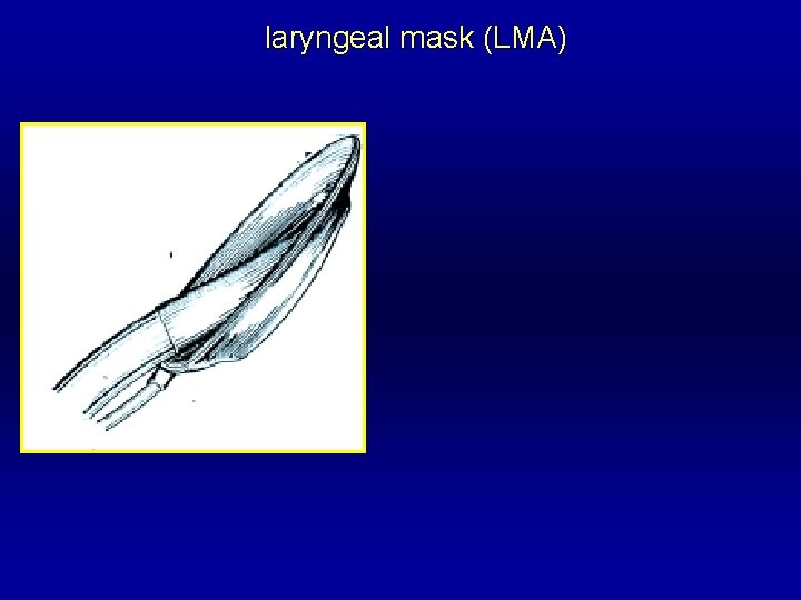 laryngeal mask (LMA) 