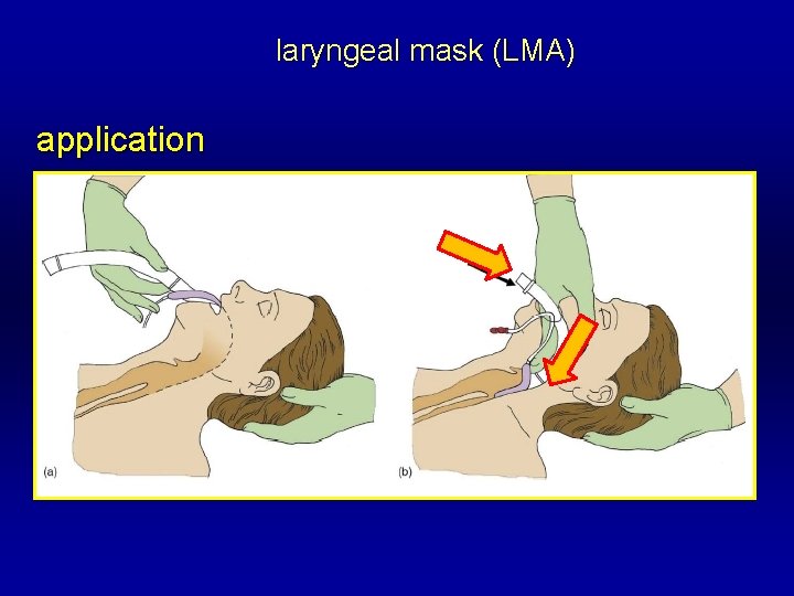 laryngeal mask (LMA) application 
